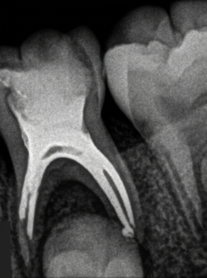 Pulpectomy